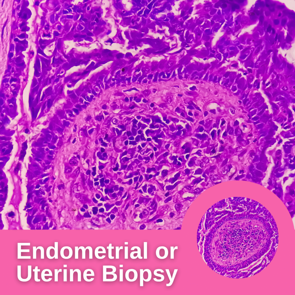 Endometrial or Uterine Biopsy
