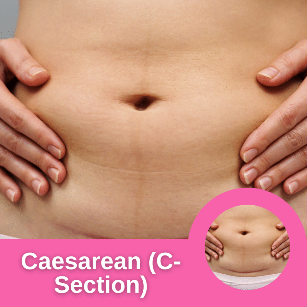 Caesarean (C-Section)